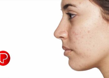 ഇത് പതിവായി ചെയ്താല്‍ മുഖത്ത് പാടുകളില്‍ മാറ്റം വരും