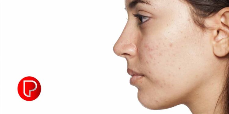 ഇത് പതിവായി ചെയ്താല്‍ മുഖത്ത് പാടുകളില്‍ മാറ്റം വരും