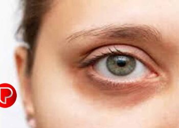 കണ്ണിന് ചുറ്റുമുള്ള കറുപ്പ് എളുപ്പം അകറ്റാം