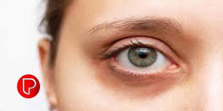 കണ്ണിന് ചുറ്റുമുള്ള കറുപ്പ് എളുപ്പം അകറ്റാം