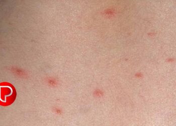 ചിക്കന്‍പോക്‌സ് ; ജാഗ്രത ലക്ഷണങ്ങൾ കണ്ടാലുടൻ ചികിത്സ തേടണമെന്ന് ആരോഗ്യ വകുപ്പ്