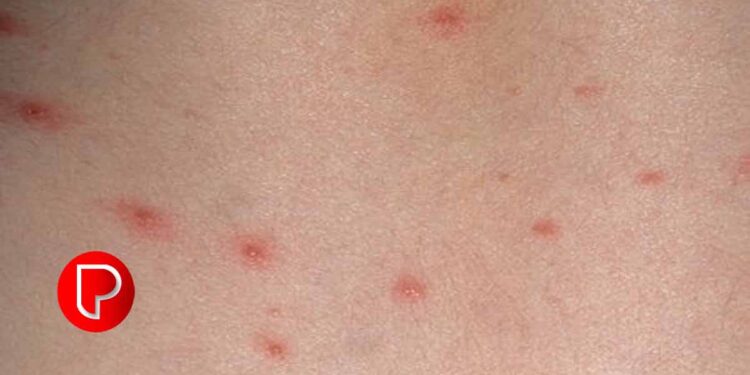 ചിക്കന്‍പോക്‌സ് ; ജാഗ്രത ലക്ഷണങ്ങൾ കണ്ടാലുടൻ ചികിത്സ തേടണമെന്ന് ആരോഗ്യ വകുപ്പ്