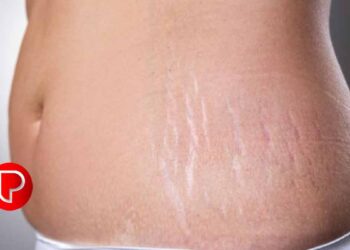 സ്ട്രെച്ച് മാർക്കുകൾ മാറാൻ ഇതു ചെയ്താൽ മതി