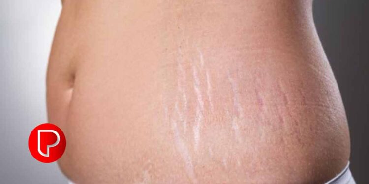 സ്ട്രെച്ച് മാർക്കുകൾ മാറാൻ ഇതു ചെയ്താൽ മതി