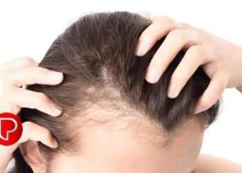 അമിത മുടികൊഴിച്ചിലുണ്ടോ? എങ്കിൽ സൂക്ഷിക്കണം ; കാരണം ഇതാണ്