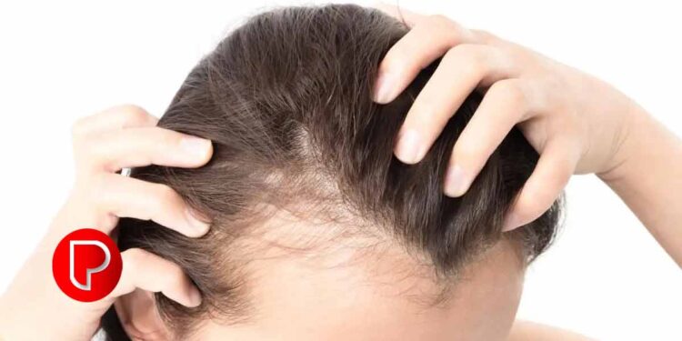 അമിത മുടികൊഴിച്ചിലുണ്ടോ? എങ്കിൽ സൂക്ഷിക്കണം ; കാരണം ഇതാണ്