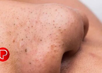 മുഖത്തെ ബ്ലാക്ക്ഹെഡ്‌സ് അകറ്റാന്‍ വീട്ടിൽ ചെയ്യേണ്ടത്