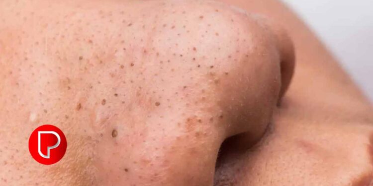 മുഖത്തെ ബ്ലാക്ക്ഹെഡ്‌സ് അകറ്റാന്‍ വീട്ടിൽ ചെയ്യേണ്ടത്