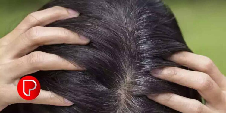 ചെറുപ്രായത്തിൽ തലമുടി നരക്കുന്നത് ഈ ഭക്ഷണങ്ങളുടെ കുറവ്