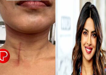 പ്രിയങ്കാ ചോപ്രയ്ക്ക് പരിക്ക്; ചിത്രം പങ്കുവെച്ച് താരം