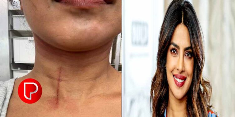 പ്രിയങ്കാ ചോപ്രയ്ക്ക് പരിക്ക്; ചിത്രം പങ്കുവെച്ച് താരം