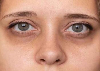 കണ്ണിന് ചുറ്റുമുള്ള കറുത്ത പാടുകൾ മാറ്റാൻ എളുപ്പമാർഗം