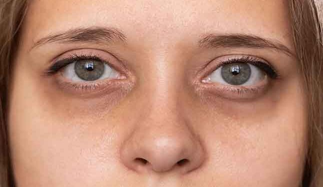 കണ്ണിന് ചുറ്റുമുള്ള കറുത്ത പാടുകൾ മാറ്റാൻ എളുപ്പമാർഗം