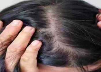 അമിതമായ മുടികൊഴിച്ചിൽ ഉണ്ടോ പരിഹാരം ഇതാ