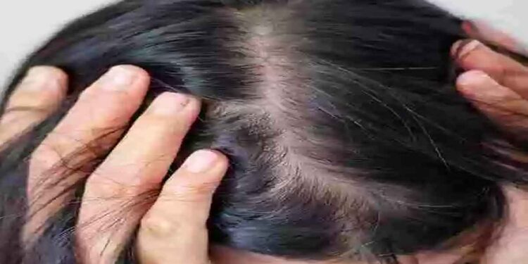 അമിതമായ മുടികൊഴിച്ചിൽ ഉണ്ടോ പരിഹാരം ഇതാ