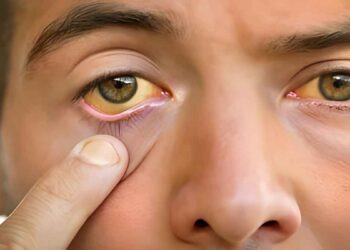 കോഴിക്കോട് കൊമ്മേരിയിൽ അഞ്ചു പേര്‍ക്ക് കൂടി മഞ്ഞപ്പിത്തം സ്ഥിരീകരിച്ചു ; രോഗം സ്ഥിരീകരിച്ചവരുടെ എണ്ണം 47