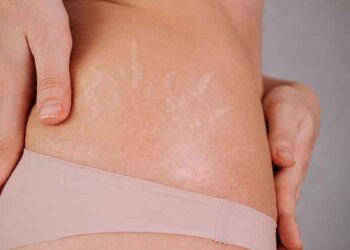 സ്ട്രെച്ച് മാര്‍ക്സ് മാറാൻ ഇനി വളരെ എളുപ്പം