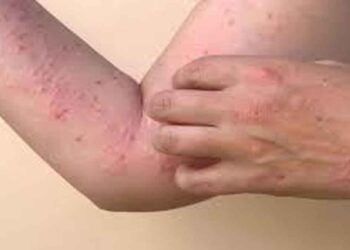 സംസ്ഥാനത്ത് ഒരാൾക്ക് കൂടി എംപോക്സ് സ്ഥിരീകരിച്ചു