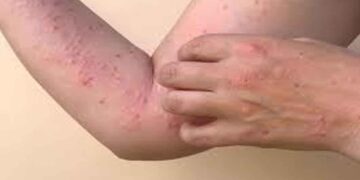 സംസ്ഥാനത്ത് ഒരാൾക്ക് കൂടി എംപോക്സ് സ്ഥിരീകരിച്ചു