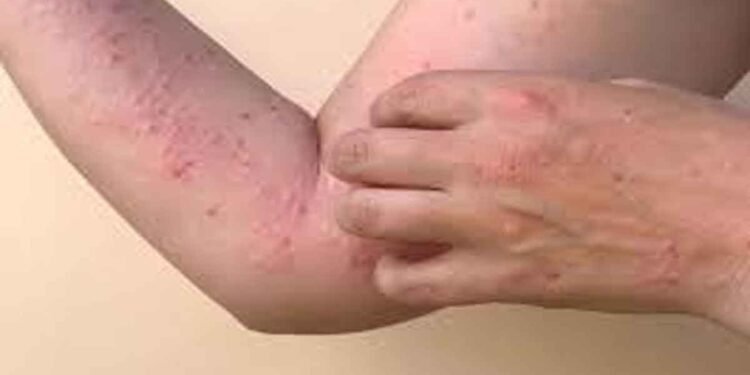 സംസ്ഥാനത്ത് ഒരാൾക്ക് കൂടി എംപോക്സ് സ്ഥിരീകരിച്ചു