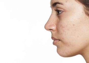 മുഖക്കുരുവിന്‍റെ ഇരുണ്ട പാടുകള്‍ അകറ്റാൻ ചെയ്യേണ്ടത്