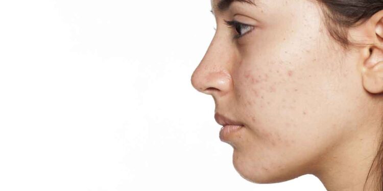 മുഖക്കുരുവിന്‍റെ ഇരുണ്ട പാടുകള്‍ അകറ്റാൻ ചെയ്യേണ്ടത്