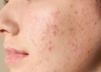 മുഖക്കുരുവിന് കാരണമാകുന്ന ഭക്ഷണങ്ങൾ