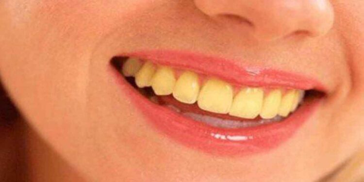 പല്ലുകളിലെ മഞ്ഞ നിറം മാറ്റാന്‍ വീട്ടില്‍ പരീക്ഷിക്കേണ്ടത്