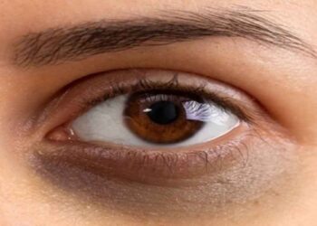 കണ്ണുകൾക്ക് താഴെയുള്ള കറുപ്പ് കുറയ്ക്കാൻ ഏറ്റവും നല്ല മാർഗം