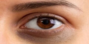 കണ്ണുകൾക്ക് താഴെയുള്ള കറുപ്പ് കുറയ്ക്കാൻ ഏറ്റവും നല്ല മാർഗം
