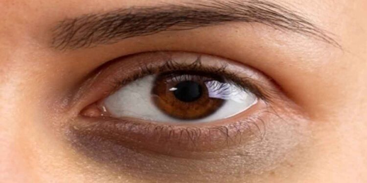 കണ്ണുകൾക്ക് താഴെയുള്ള കറുപ്പ് കുറയ്ക്കാൻ ഏറ്റവും നല്ല മാർഗം