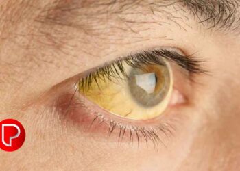 കുന്ദമംഗലം ഗ്രാമപഞ്ചായത്തില്‍ വിവിധ വാർഡുകളില്‍ മഞ്ഞപ്പിത്തം വ്യാപകം; പ്രതിരോധം ഊര്‍ജിതമാക്കി