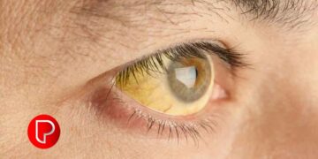 കുന്ദമംഗലം ഗ്രാമപഞ്ചായത്തില്‍ വിവിധ വാർഡുകളില്‍ മഞ്ഞപ്പിത്തം വ്യാപകം; പ്രതിരോധം ഊര്‍ജിതമാക്കി