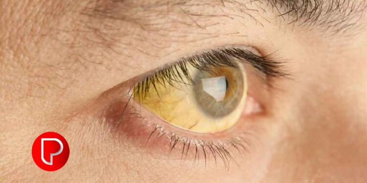 കുന്ദമംഗലം ഗ്രാമപഞ്ചായത്തില്‍ വിവിധ വാർഡുകളില്‍ മഞ്ഞപ്പിത്തം വ്യാപകം; പ്രതിരോധം ഊര്‍ജിതമാക്കി