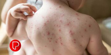 മഴ മാറി, ചൂടുകൂടി നാടെങ്ങും ചിക്കൻ പോക്സ്