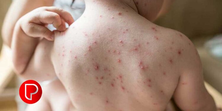 മഴ മാറി, ചൂടുകൂടി നാടെങ്ങും ചിക്കൻ പോക്സ്