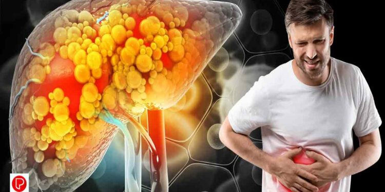 കൊഴുപ്പ് കുറയ്ക്കാം, ഫാറ്റി ലിവറിനെ പിടിച്ചുകെട്ടാം അറിഞ്ഞിരിക്കേണ്ടത്