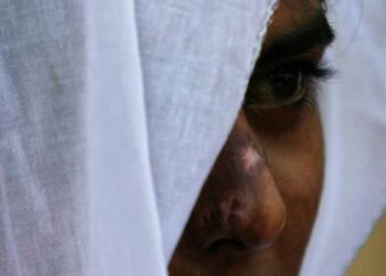 വയനാട്ടിൽ പതിനാലുകാരിക്ക് നേരെ വയോധികന്റെ ക്രൂരത ; ആസിഡ് ആക്രമണത്തിൽ പെൺകുട്ടിക്ക് ഗുരുതര പരുക്ക്